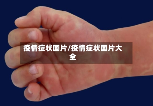 疫情症状图片/疫情症状图片大全