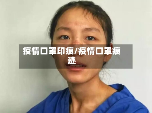 疫情口罩印痕/疫情口罩痕迹