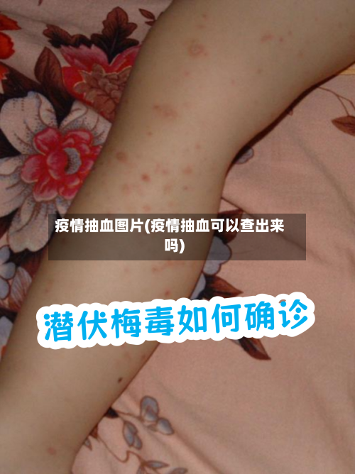 疫情抽血图片(疫情抽血可以查出来吗)-第3张图片